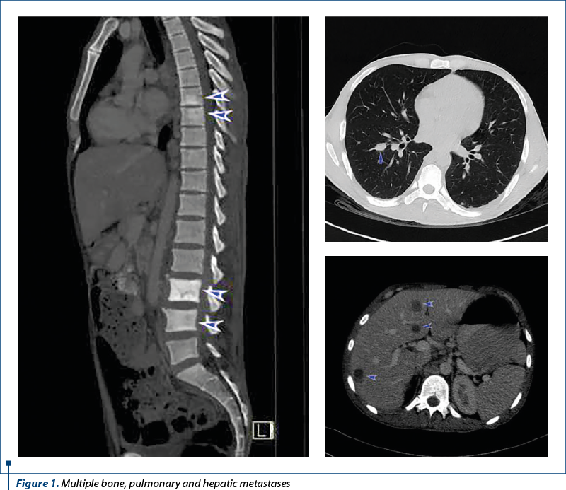 Figure 1. Multiple bone, pulmonary and hepatic metastases