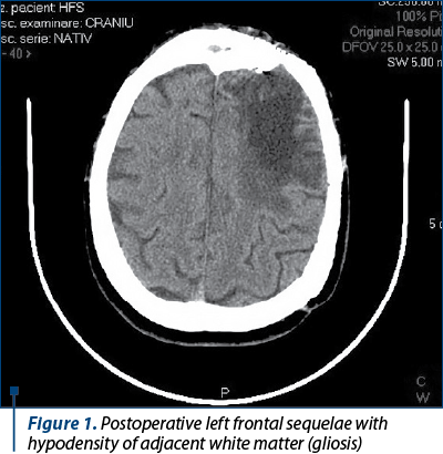 Figure 1. Postoperative left frontal sequelae with hypodensity of adjacent white matter (gliosis)