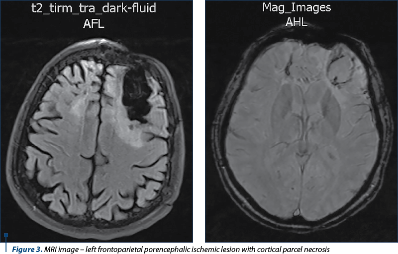 Figure 3. MRI image – left frontoparietal porencephalic ischemic lesion with cortical parcel necrosis