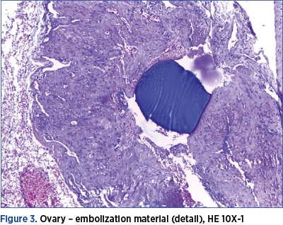 Figure 3. Ovary – embolization material (detail), HE 10X-1