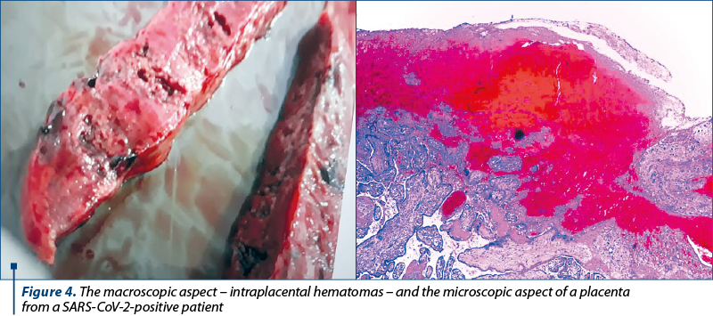 Figure 4. The macroscopic aspect – intraplacental hematomas – and the microscopic aspect of a placenta  from a SARS-CoV-2-positive patient