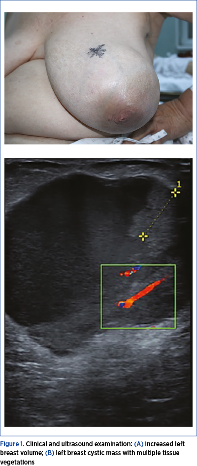 Figure 1. Clinical and ultrasound examination: (A) increased left breast volume; (B) left breast cystic mass with multiple tissue vegetations