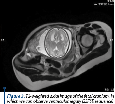 Figure 3. T2-weighted axial image of the fetal cranium, in which we can observe ventriculomegaly (SSFSE sequence) 