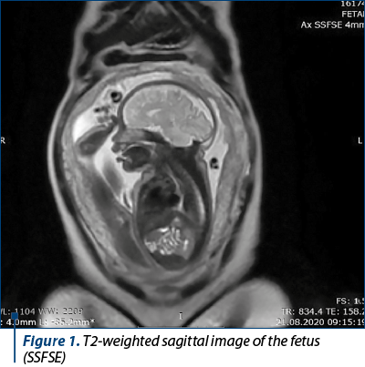 Figure 1. T2-weighted sagittal image of the fetus (SSFSE)