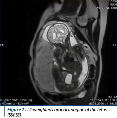 Figure 2. T2-weighted coronal imagine of the fetus (SSFSE)