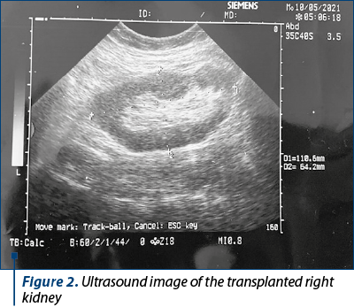 Figure 2. Ultrasound image of the transplanted right kidney