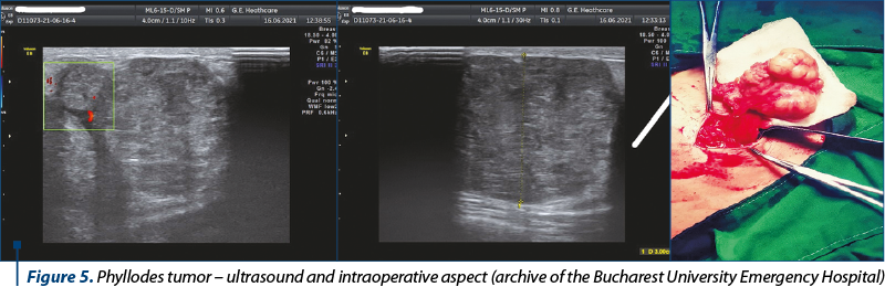 Figure 5. Phyllodes tumor – ultrasound and intraoperative aspect (archive of the Bucharest University Emergency Hospital)