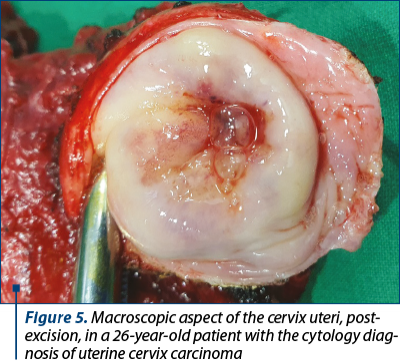 Figure 5. Macroscopic aspect of the cervix uteri, post­excision, in a 26-year-old patient with the cytology diag­nosis of uterine cervix carcinoma