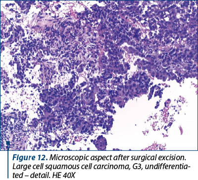 Figure 12. Microscopic aspect after surgical excision. Large cell squamous cell carcinoma, G3, undif­feren­tia­ted – detail. HE 40X