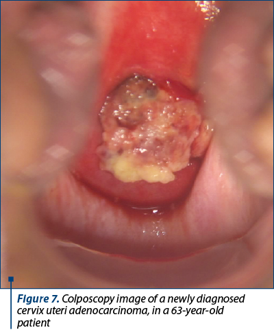 Figure 7. Colposcopy image of a newly diagnosed  cervix uteri adenocarcinoma, in a 63-year-old  patient 