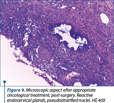 Figure 9. Microscopic aspect after appropriate oncological treatment, post-surgery. Reactive endocervical glands, pseudostratified nuclei. HE 40X