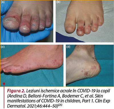Figura 2. Leziuni ischemice acrale în COVID-19 la copil (Andina D, Belloni-Fortina A, Bodemer C, et al. Skin manifestations of COVID-19 in children, Part 1. Clin Exp Dermatol. 2021;46:444–50)(25) 