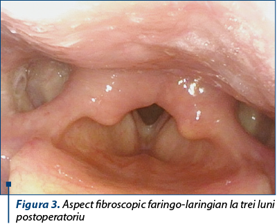 Figura 3. Aspect fibroscopic faringo-laringian la trei luni postoperatoriu