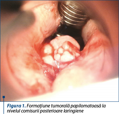 Figura 1. Formaţiune tumorală papilomatoasă la nivelul comisurii posterioare laringiene