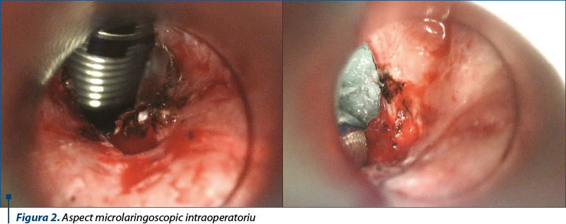 Figura 2. Aspect microlaringoscopic intraoperatoriu