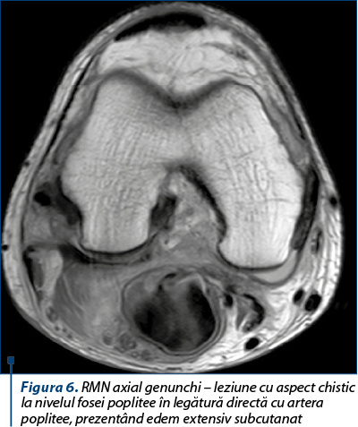 Figura 6. RMN axial genunchi – leziune cu aspect chistic la nivelul fosei poplitee în legătură directă cu artera poplitee, prezentând edem extensiv subcutanat