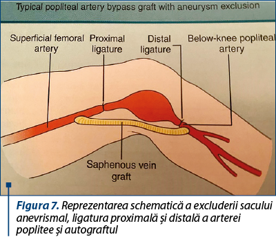 Figura 7. Reprezentarea schematică a excluderii sacului anevrismal, ligatura proximală şi distală a arterei poplitee şi autograftul