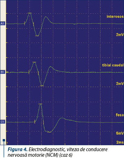 Figura 4. Electrodiagnostic, viteza de conducere nervoasă motorie (NCM) (caz 6)
