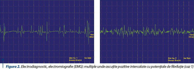 Figura 2. Electrodiagnostic, electromiografie (EMG): multiple unde ascuţite pozitive intercalate cu potenţiale de fibrilaţie (caz 1)