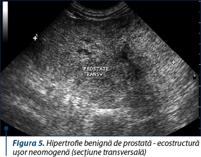 Figura 5. Hipertrofie benignă de prostată - ecostructură uşor neomogenă (secţiune transversală)