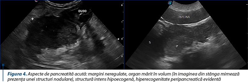 Figura 4. Aspecte de pancreatită acută: margini neregulate, organ mărit în volum (în imaginea din stânga mimează prezenţa unei structuri nodulare), structură intens hipoecogenă, hiperecogenitate peripancreatică evidentă