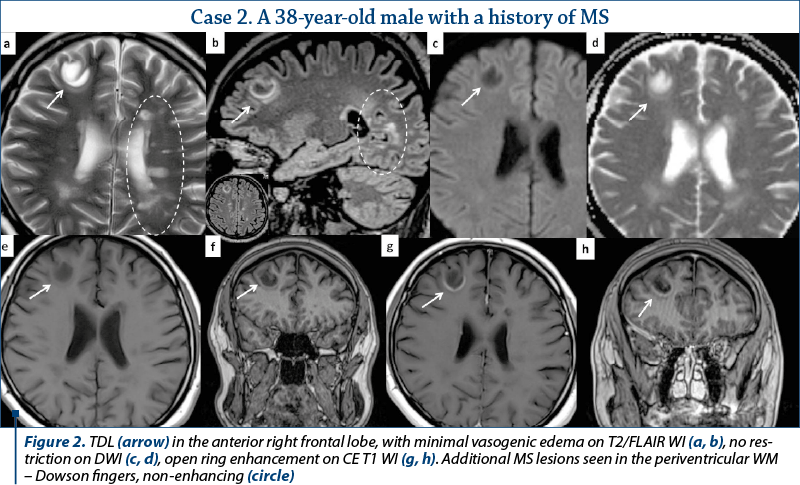 Figure 2. TDL (arrow) in the anterior right frontal lobe, with minimal vasogenic edema on T2/FLAIR WI (a, b), no res­tric­tion on DWI (c, d), open ring enhancement on CE T1 WI (g, h). Additional MS lesions seen in the periventricular WM – Dowson fingers, non-enhancing (circle)
