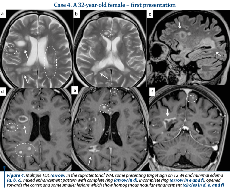 Figure 4. Multiple TDL (arrow) in the supratentorial WM, some presenting target sign on T2 WI and minimal edema (a, b, c), mixed enhancement pattern with complete ring (arrow in d), incomplete ring (arrow in e and f), opened towards the cortex and some smaller lesions which show homogenous nodular enhancement (circles in d, e, and f) 