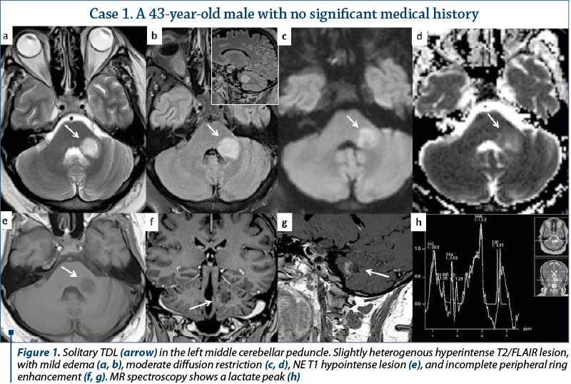 Figure 1. Solitary TDL (arrow) in the left middle cerebellar peduncle. Slightly heterogenous hyperintense T2/FLAIR lesion, with mild edema (a, b), moderate diffusion restriction (c, d), NE T1 hypointense lesion (e), and incomplete peripheral ring enhancement (f, g). MR spectroscopy shows a lactate peak (h)
