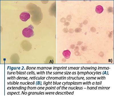 Figure 2. Bone marrow imprint smear showing imma­ture/blast cells, with the same size as lymphocytes (A), with dense, reticular chromatin structure, some with visible nucleoli (B), light blue cytoplasm with a tail extending from one point of the nucleus – hand mirror aspect. No granules were described