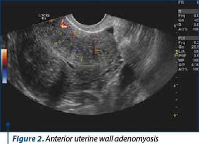Figure 2. Anterior uterine wall adenomyosis