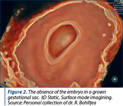 Figure 2. The absence of the embryo in a grown gestational sac. 3D Static, Surface mode imagining. Source: Personal collection of dr. R. Bohîlţea
