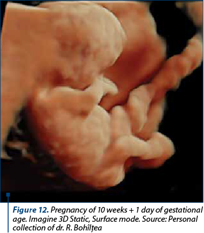 Figure 12. Pregnancy of 10 weeks + 1 day of gestational age. Imagine 3D Static, Surface mode. Source: Personal collection of dr. R. Bohîlţea 