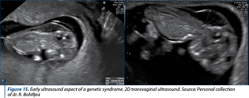 Figure 15. Early ultrasound aspect of a genetic syndrome. 2D transvaginal ultrasound. Source: Personal collection  of dr. R. Bohîlţea 