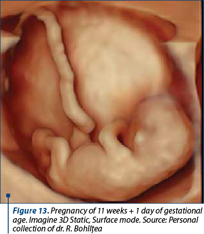 Figure 13. Pregnancy of 11 weeks + 1 day of gestational age. Imagine 3D Static, Surface mode. Source: Personal collection of dr. R. Bohîlţea 