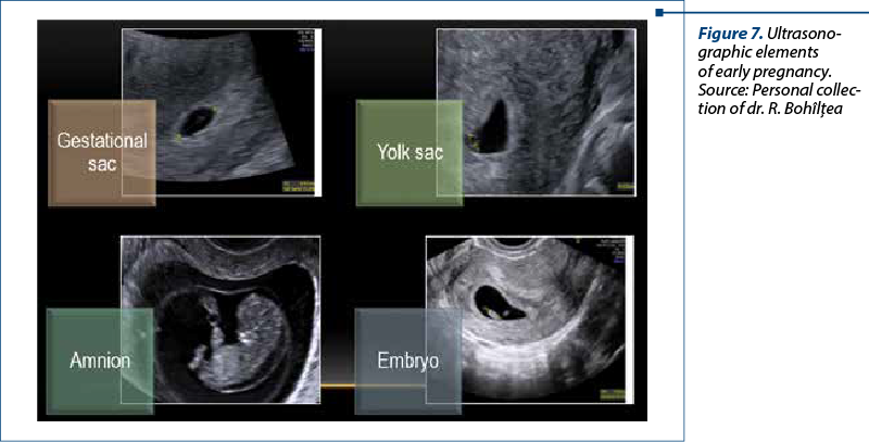 Figure 7. Ultrasono­graphic elements  of early pregnancy.  Source: Per­sonal col­lec­tion of dr. R. Bohîlţea  