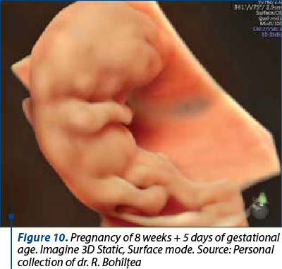 Figure 10. Pregnancy of 8 weeks + 5 days of gestational age. Imagine 3D Static, Surface mode. Source: Personal collection of dr. R. Bohîlţea 