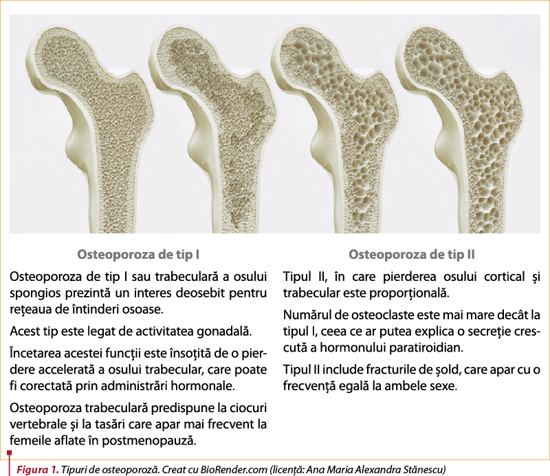 Figura 1. Tipuri de osteoporoză. Creat cu BioRender.com (licenţă: Ana Maria Alexandra Stănescu)