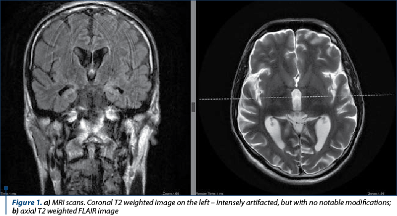 Figure 1. a) MRI scans. Coronal T2 weighted image on the left – intensely artifacted, but with no notable modifications; b) axial T2 weighted FLAIR image