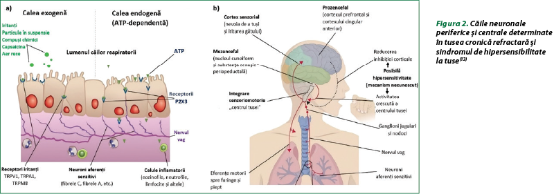Figura 2. Căile neuronale periferice şi centrale determinate în tusea cronică refractară şi sindromul de hipersensibilitate la tuse(13)