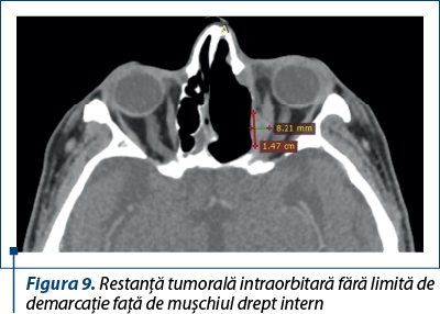 Figura 9. Restanţă tumorală intraorbitară fără limită de demarcaţie faţă de muşchiul drept intern
