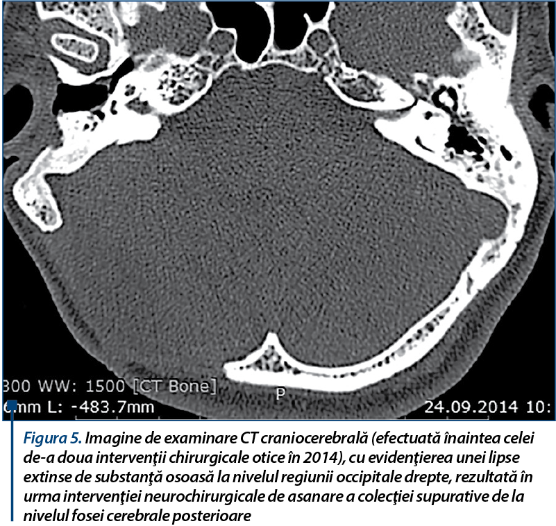 Figura 5. Imagine de examinare CT craniocerebrală (efectuată înaintea celei de-a doua intervenţii chirurgicale otice în 2014), cu evidenţierea unei lipse extinse de substanţă osoasă la nivelul regiunii occipitale drepte, rezultată în urma intervenţiei neurochirurgicale de asanare a colecţiei supurative de la nivelul fosei cerebrale posterioare