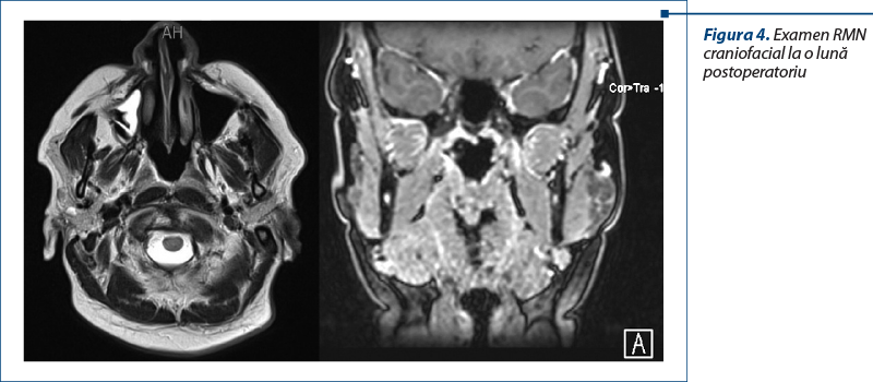 Figura 4. Examen RMN craniofacial la o lună postoperatoriu
