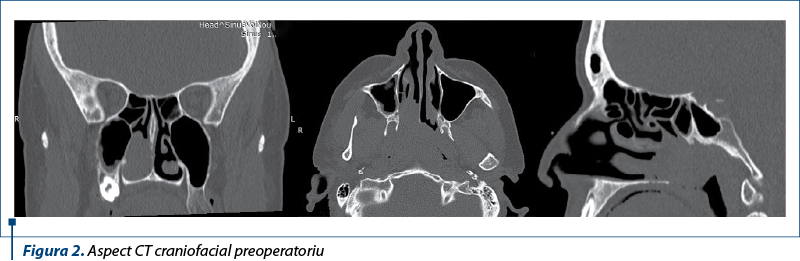 Figura 2. Aspect CT craniofacial preoperatoriu