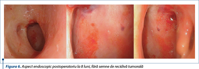 Figura 6. Aspect endoscopic postoperatoriu la 8 luni, fără semne de recidivă tumorală