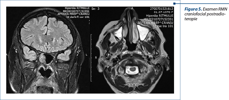 Figura 5. Examen RMN craniofacial postradio­terapie