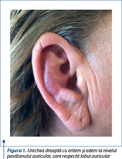 Figura 1. Urechea dreaptă cu eritem şi edem la nivelul pavilionului auricular, care respectă lobul auricular