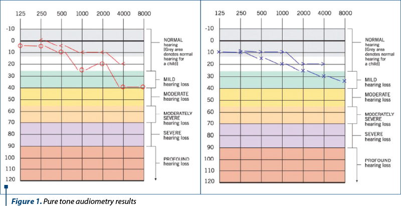 Figure 1. Pure tone audiometry results