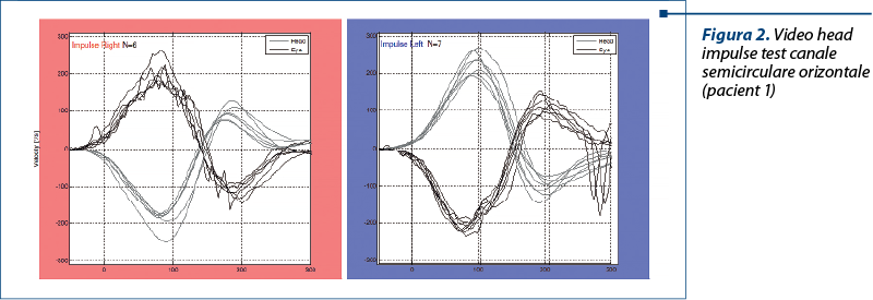 Figura 2. Video head impulse test canale semicirculare orizontale (pacient 1)