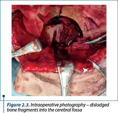 Figure 2.3. Intraoperative photography – dislodged bone fragments into the cerebral fossa