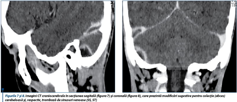 Figurile 7 şi 8. Imagini CT craniocerebrale în secţiunea sagitală (figura 7) şi coronală (figura 8), care prezintă modificări sugestive pentru colecţie (abces) cerebeloasă şi, respectiv, tromboză de sinusuri venoase (SS, ST)